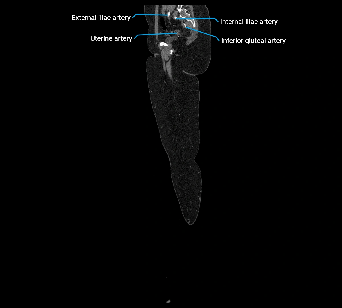 CTA lower limb sagittal cross sectional anatomy labelled image _10 (2).webp